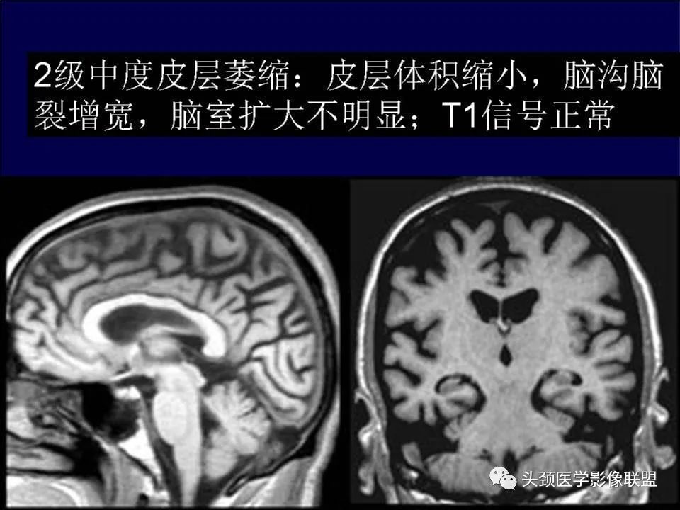 【PPT】脑皮层病变的MRI表现-36