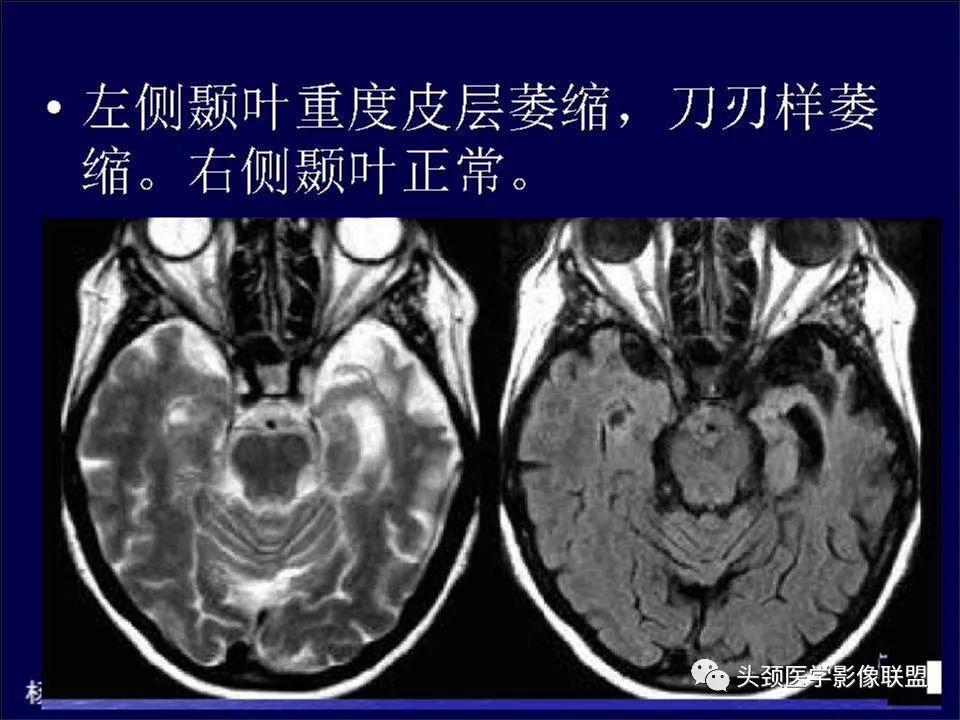 【PPT】脑皮层病变的MRI表现-37