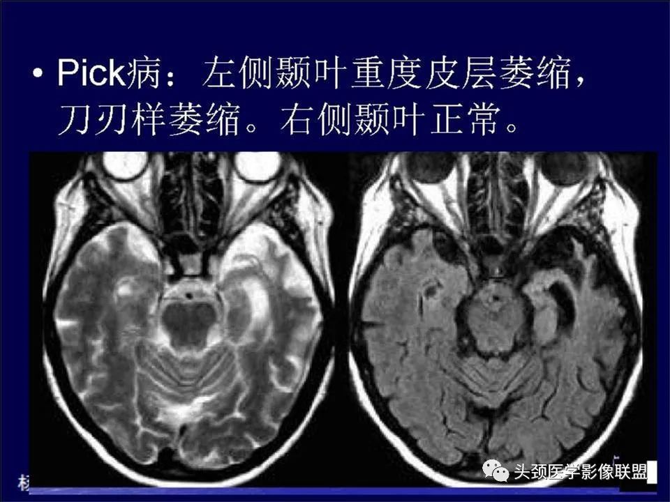 【PPT】脑皮层病变的MRI表现-40