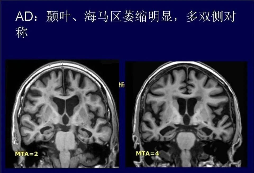 【PPT】脑皮层病变的MRI表现-41