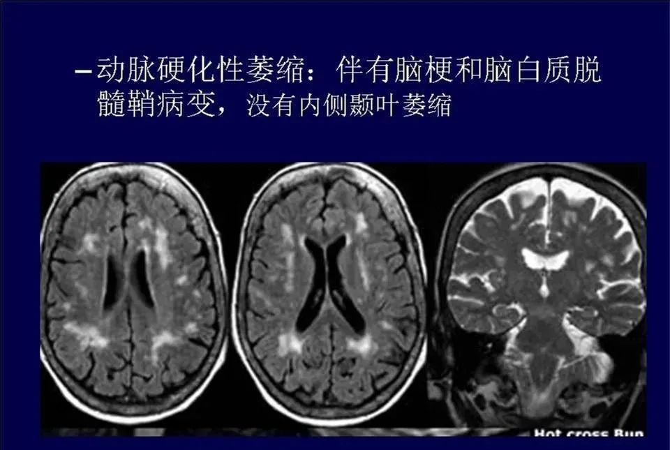 【PPT】脑皮层病变的MRI表现-42