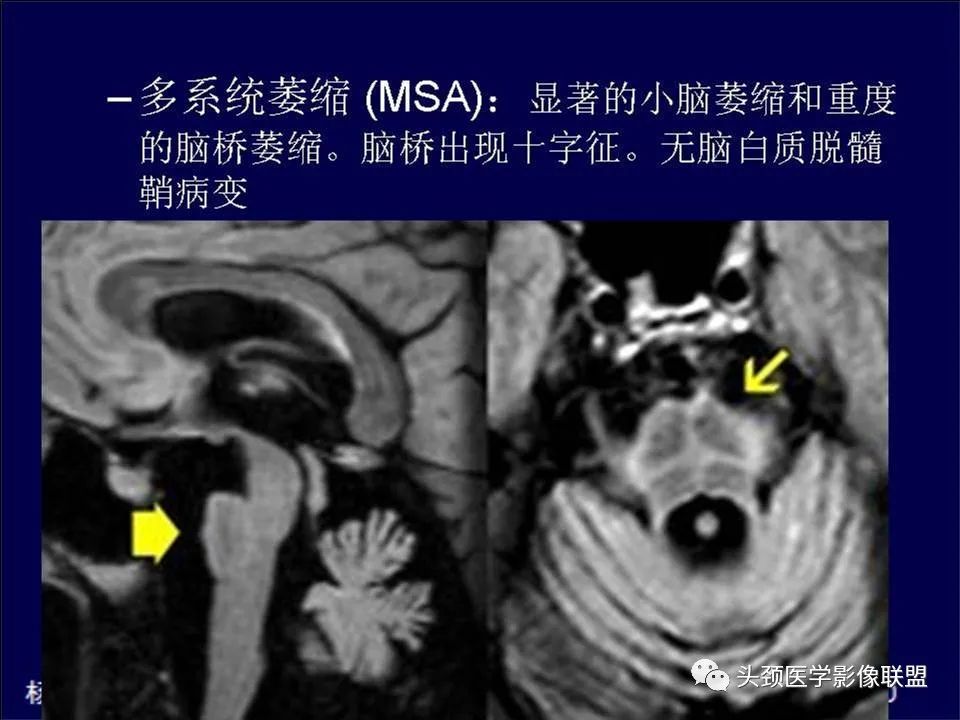 【PPT】脑皮层病变的MRI表现-43