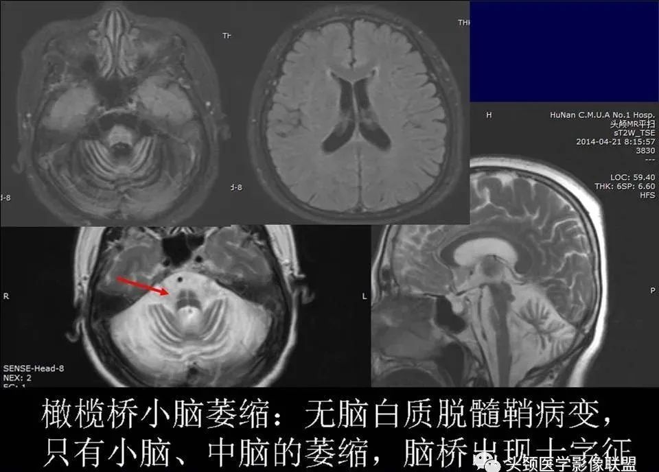 【PPT】脑皮层病变的MRI表现-44