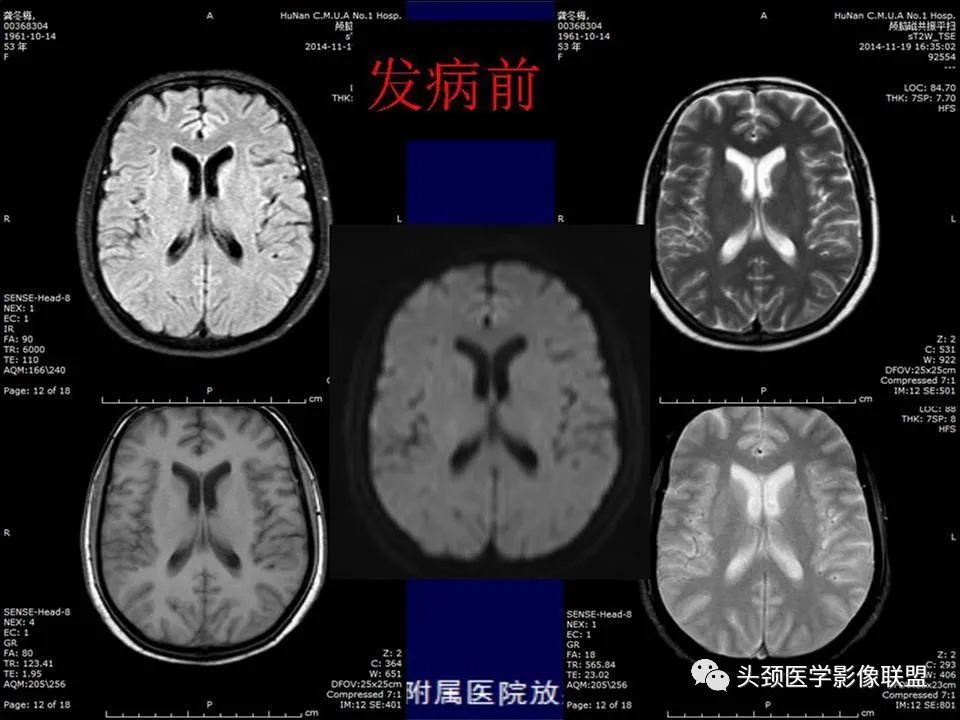 【PPT】脑皮层病变的MRI表现-48