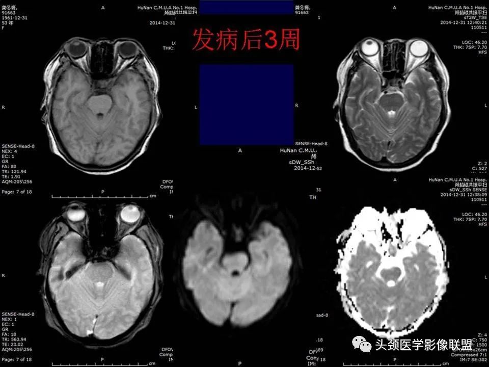 【PPT】脑皮层病变的MRI表现-50