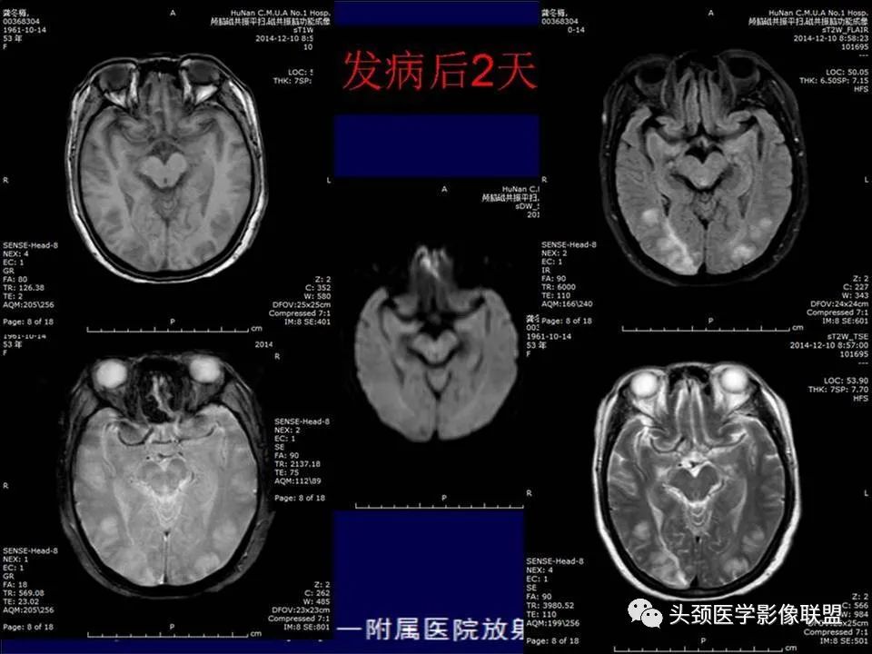 【PPT】脑皮层病变的MRI表现-49
