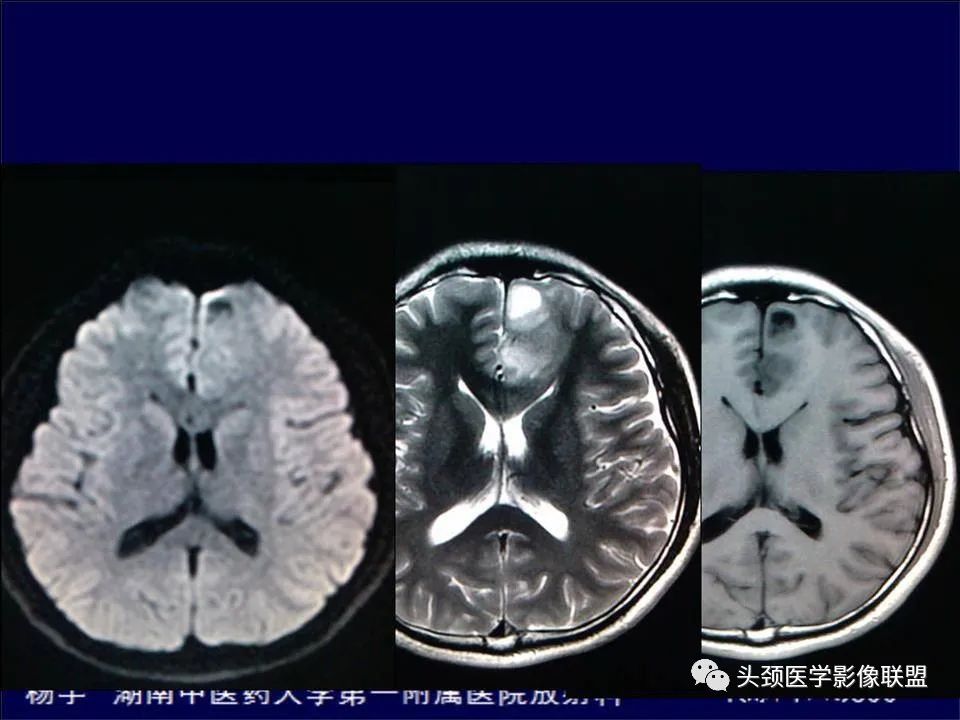 【PPT】脑皮层病变的MRI表现-52