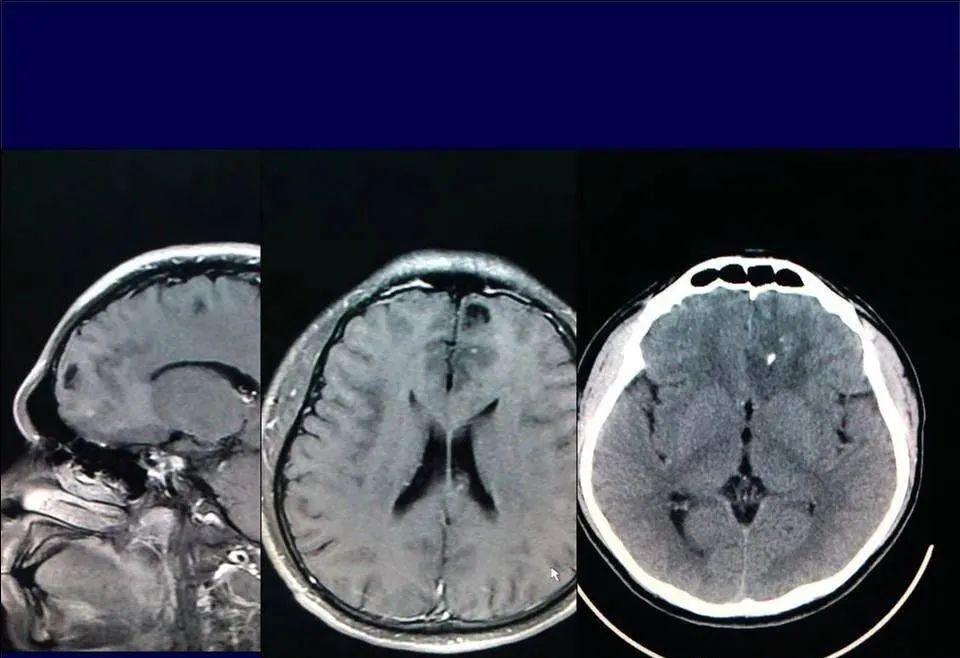 【PPT】脑皮层病变的MRI表现-53