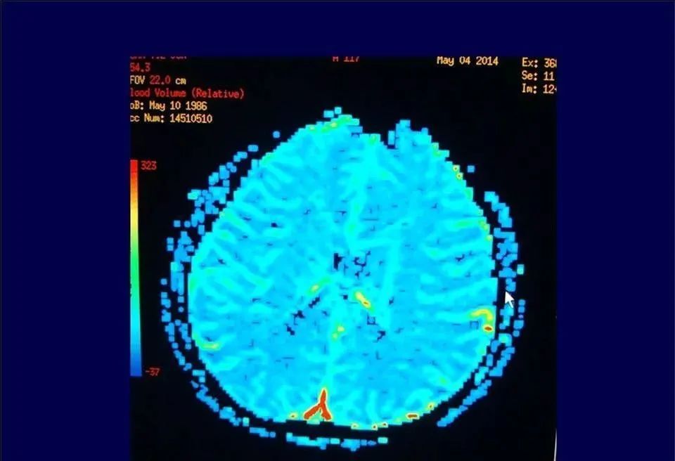 【PPT】脑皮层病变的MRI表现-54