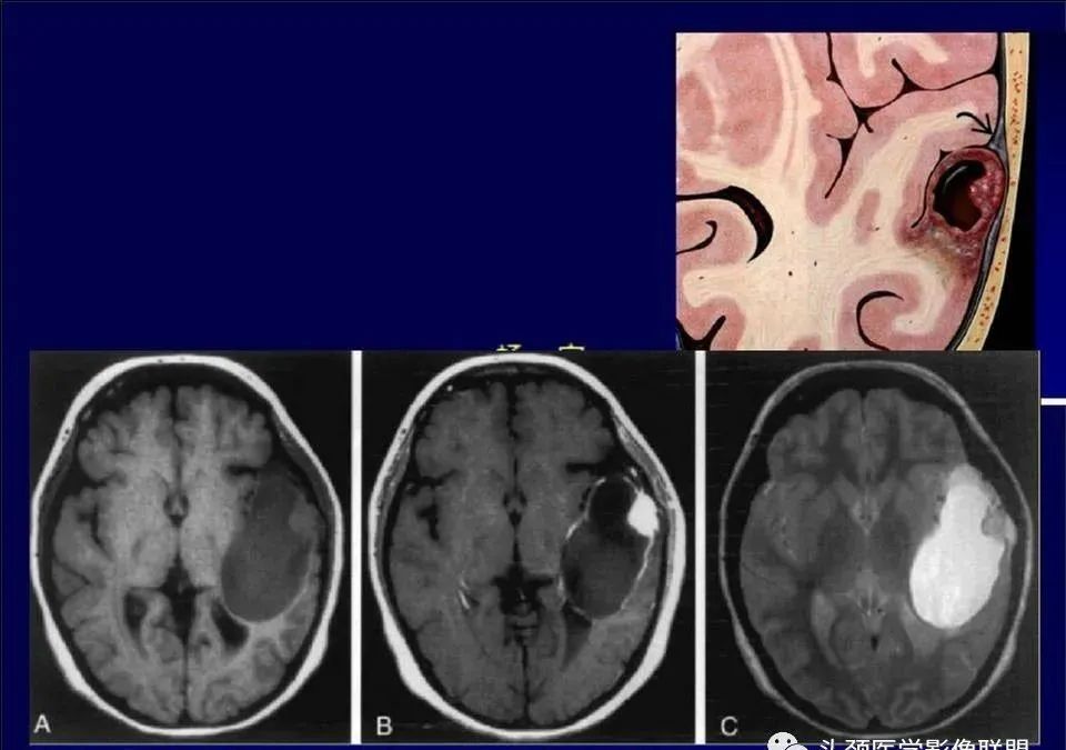 【PPT】脑皮层病变的MRI表现-56