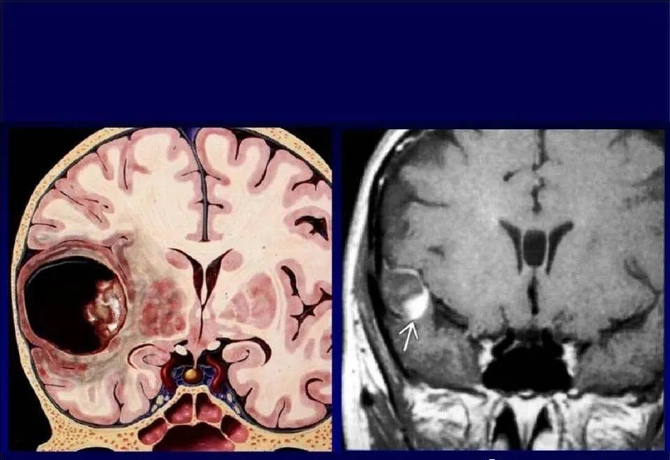 【PPT】脑皮层病变的MRI表现-58