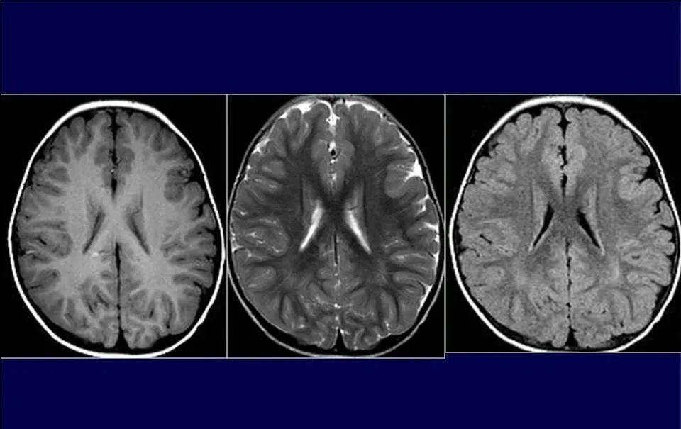 【PPT】脑皮层病变的MRI表现-61