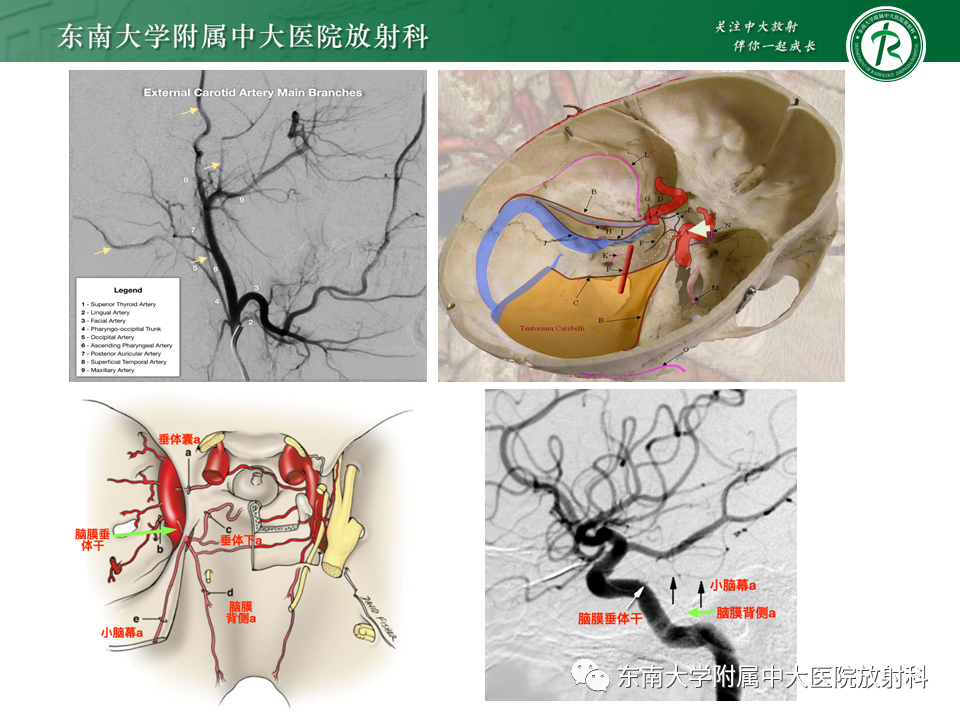 【PPT】高流量脑血管畸形-24