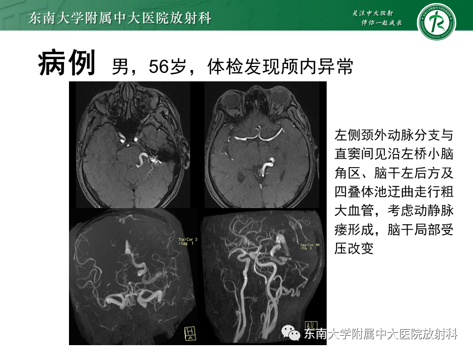 【PPT】高流量脑血管畸形-32