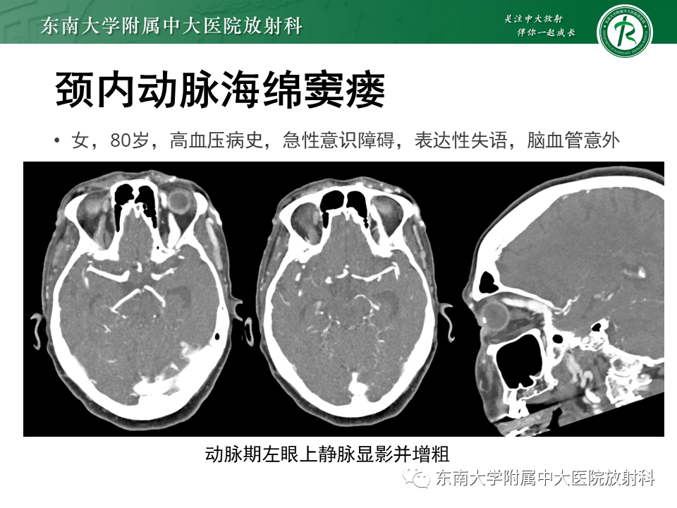 【PPT】高流量脑血管畸形-36