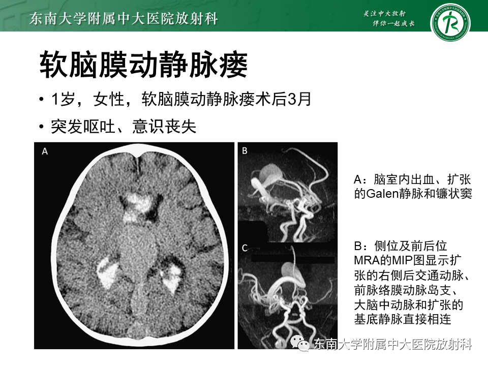 【PPT】高流量脑血管畸形-38