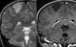 胚胎发育不良性神经上皮肿瘤DNET的影像表现-2