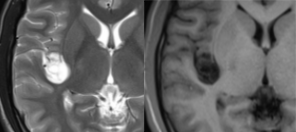 胚胎发育不良性神经上皮肿瘤DNET的影像表现-3