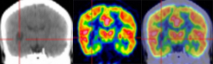 胚胎发育不良性神经上皮肿瘤DNET的影像表现-5