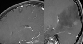 胚胎发育不良性神经上皮肿瘤DNET的影像表现-6