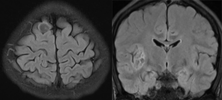 胚胎发育不良性神经上皮肿瘤DNET的影像表现-4