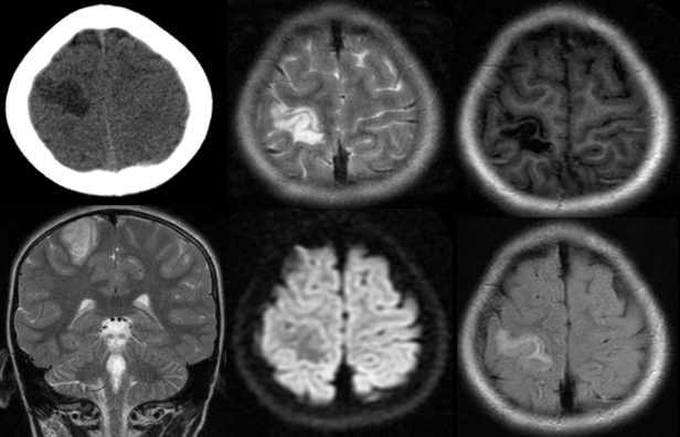 胚胎发育不良性神经上皮肿瘤DNET的影像表现-7