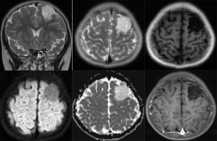胚胎发育不良性神经上皮肿瘤DNET的影像表现-9