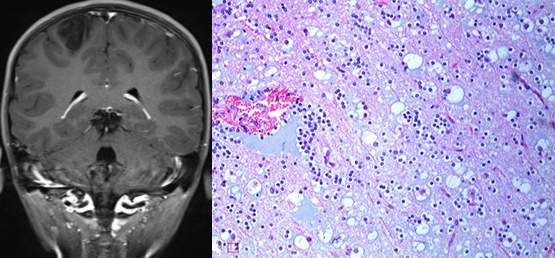 胚胎发育不良性神经上皮肿瘤DNET的影像表现-8