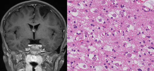 胚胎发育不良性神经上皮肿瘤DNET的影像表现-10