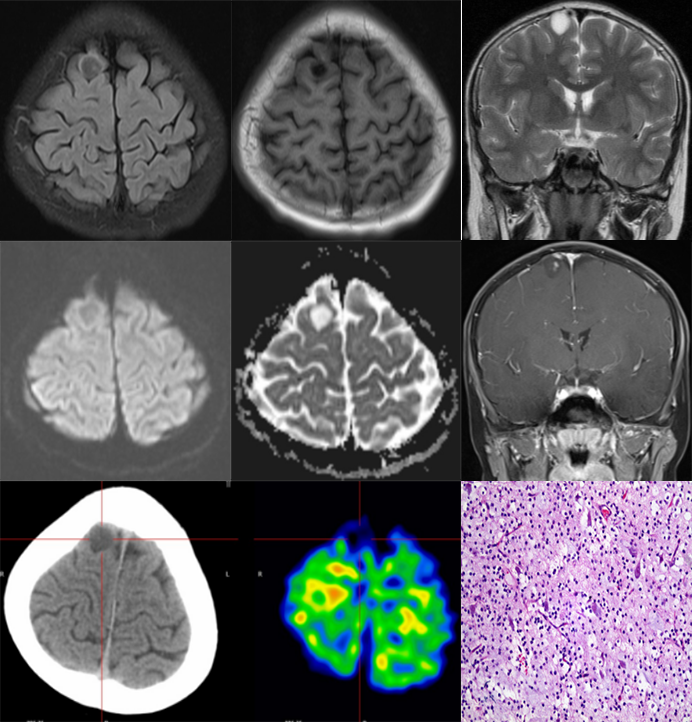 胚胎发育不良性神经上皮肿瘤DNET的影像表现-11