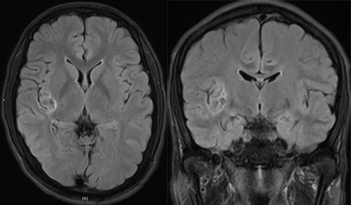 胚胎发育不良性神经上皮肿瘤DNET的影像表现-13