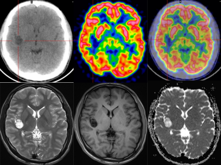 胚胎发育不良性神经上皮肿瘤DNET的影像表现-12