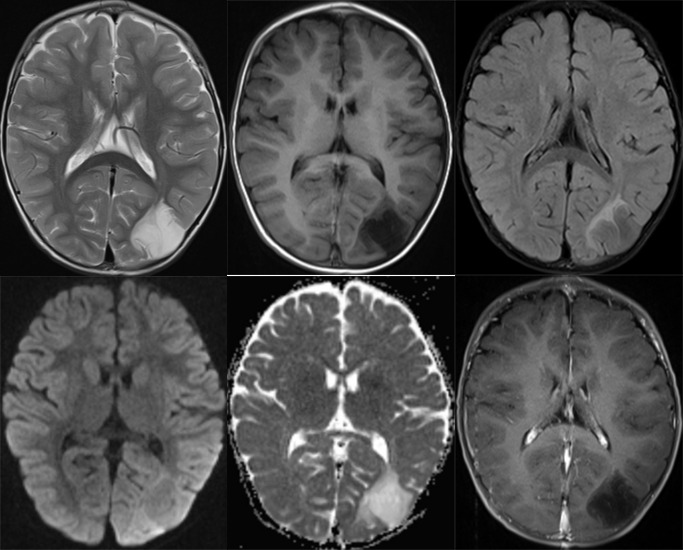 胚胎发育不良性神经上皮肿瘤DNET的影像表现-14