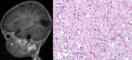 胚胎发育不良性神经上皮肿瘤DNET的影像表现-15