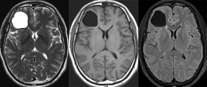 胚胎发育不良性神经上皮肿瘤DNET的影像表现-16