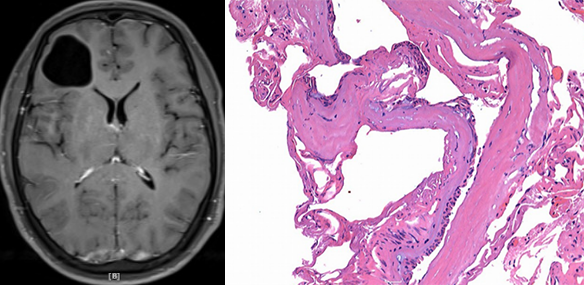 胚胎发育不良性神经上皮肿瘤DNET的影像表现-17