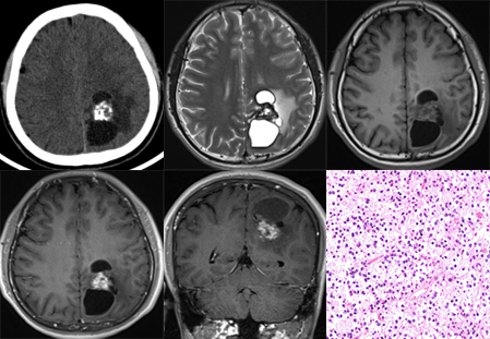 胚胎发育不良性神经上皮肿瘤DNET的影像表现-19