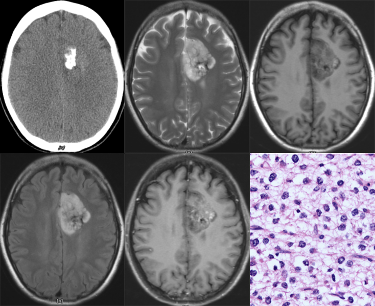 胚胎发育不良性神经上皮肿瘤DNET的影像表现-18