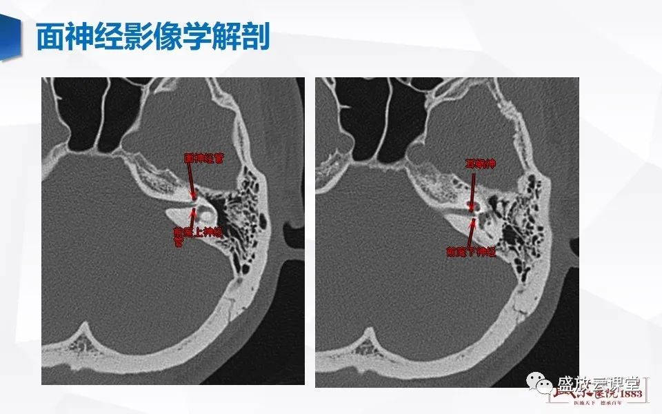 【PPT】面神经MR评估-8