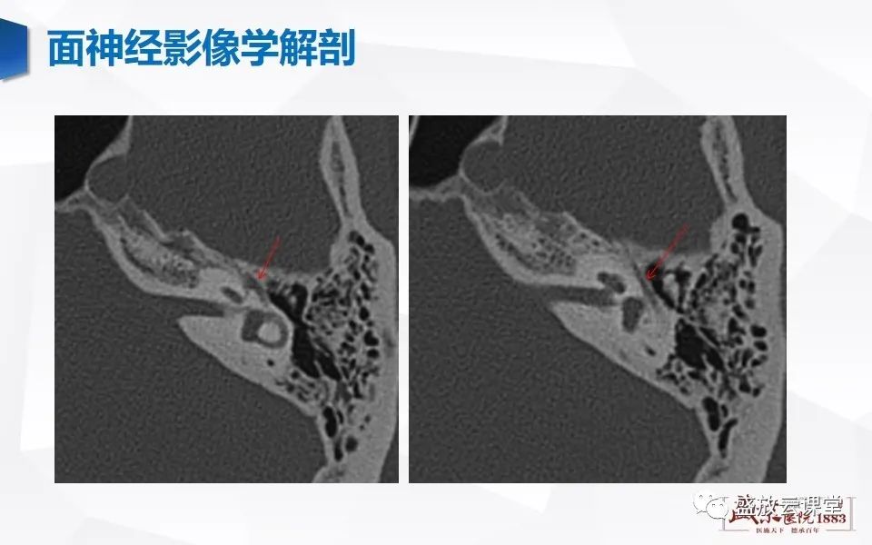 【PPT】面神经MR评估-9