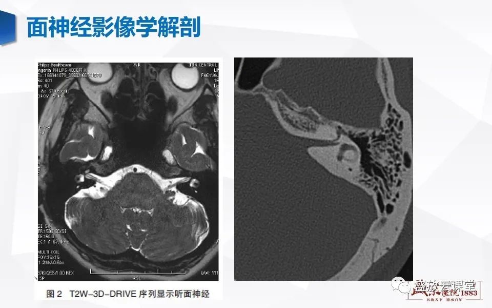 【PPT】面神经MR评估-10