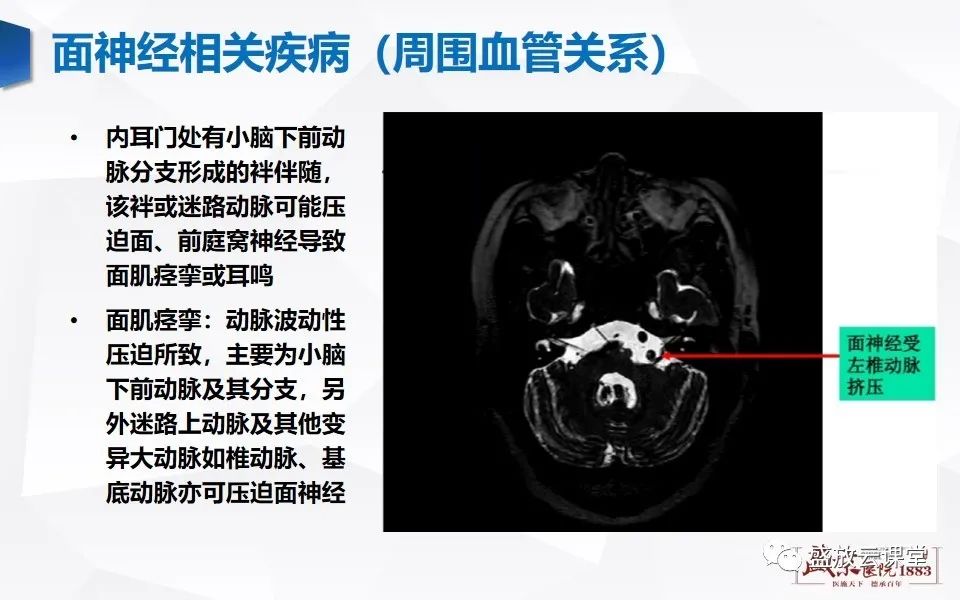 【PPT】面神经MR评估-12