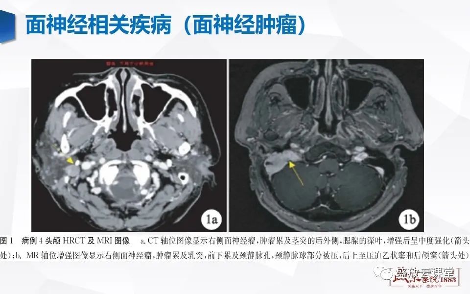 【PPT】面神经MR评估-14