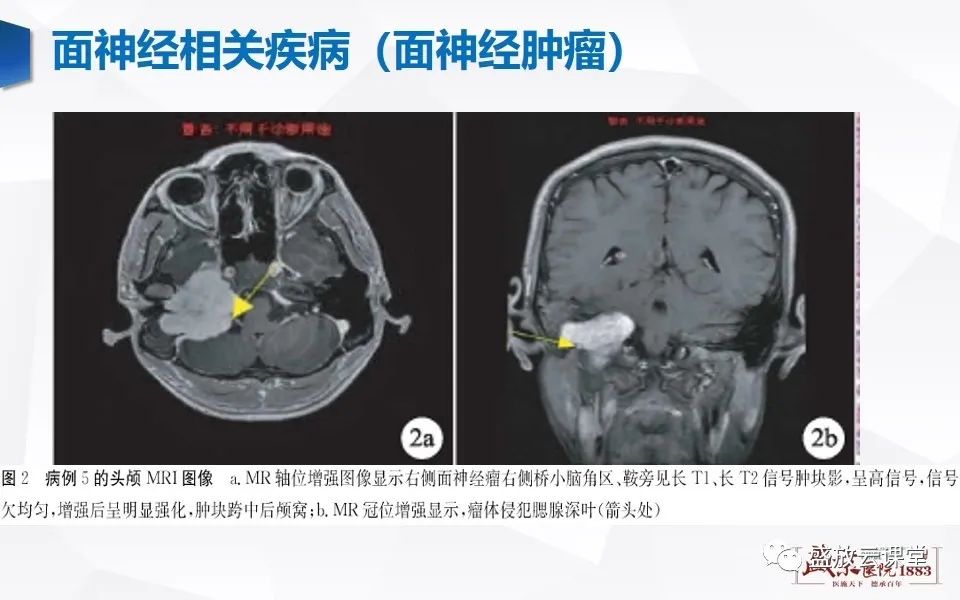 【PPT】面神经MR评估-15