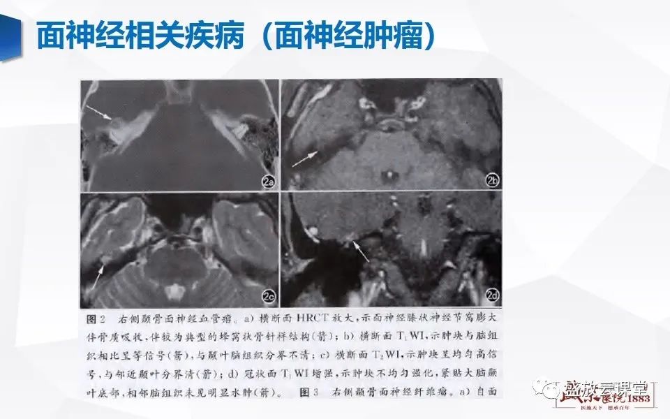 【PPT】面神经MR评估-16