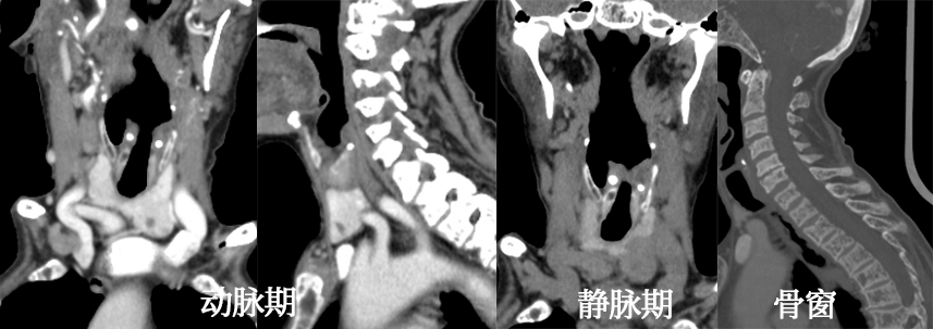 甲状旁腺病变CT特点-3