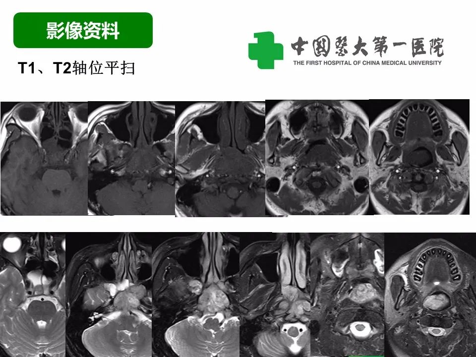 【病例】鼻咽部肌上皮癌1例CT及MR影像-5