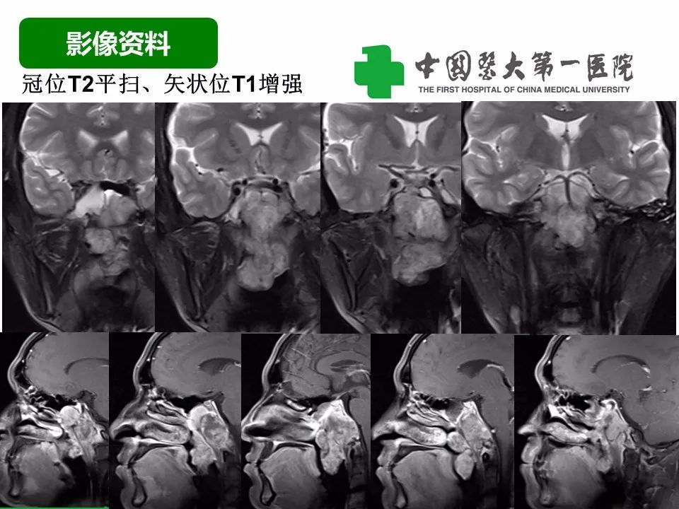 【病例】鼻咽部肌上皮癌1例CT及MR影像-6