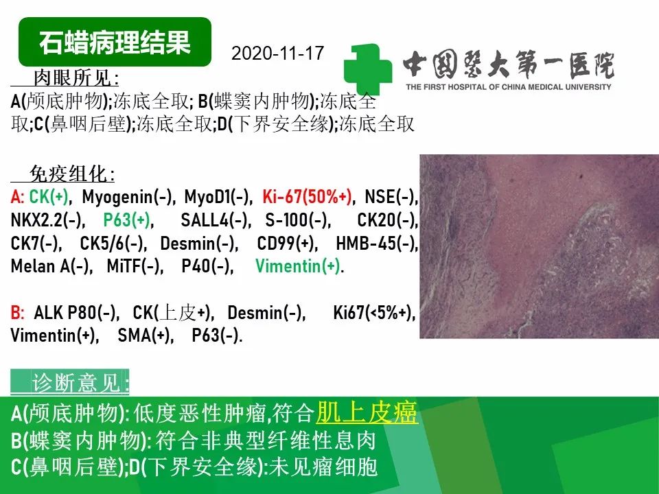 【病例】鼻咽部肌上皮癌1例CT及MR影像-9