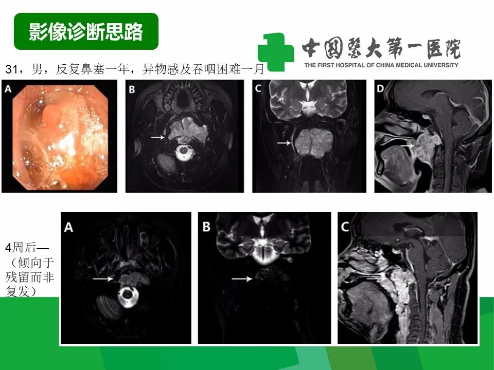 【病例】鼻咽部肌上皮癌1例CT及MR影像-13